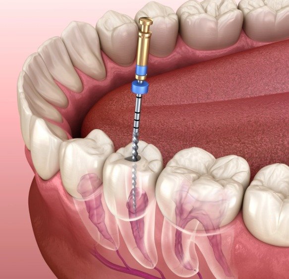 Root Canal Treatment